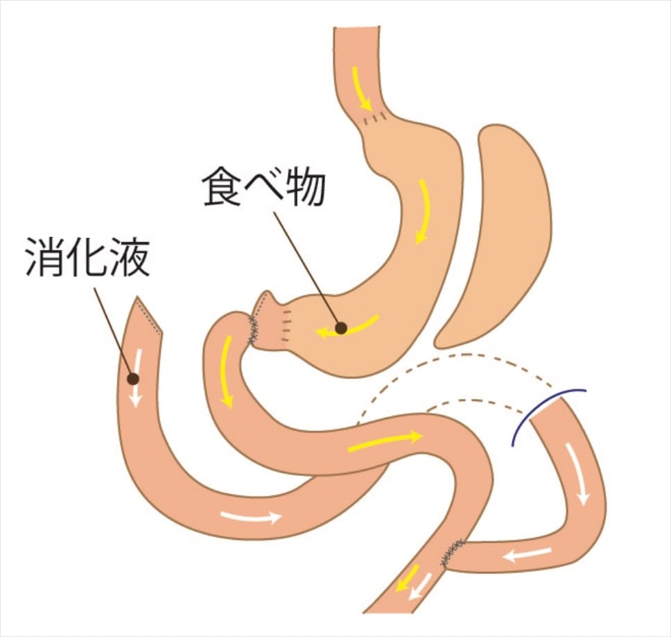 腹腔鏡下スリーブ状胃切除術（スリーブ術）